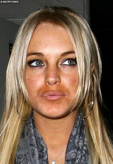 lindsay-lohan-collagen-lips.jpg